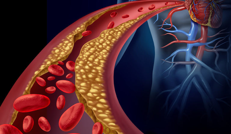 ជាតិខ្លាញ់នៅក្នុងឈាម អាចទប់ស្កាត់និងលុបបំបាត់បន្តិចម្តងៗ ប្រសិនបើអ្នកឧស្សាហ៍ទទួលទានអាហារទាំង ៥ ប្រភេទដូចបានរៀបរាប់ខាងក្រោម។ រូបថតពី៖ Health.com.kh