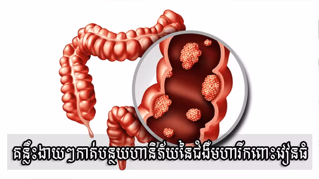 ចង់​កាត់បន្ថយ​ហានិភ័យ​នៃ​ជំងឺមហារីក​ពោះវៀនធំ កុំ​រំលង​គន្លឹះ​ទាំងនេះ​! ảnh 1