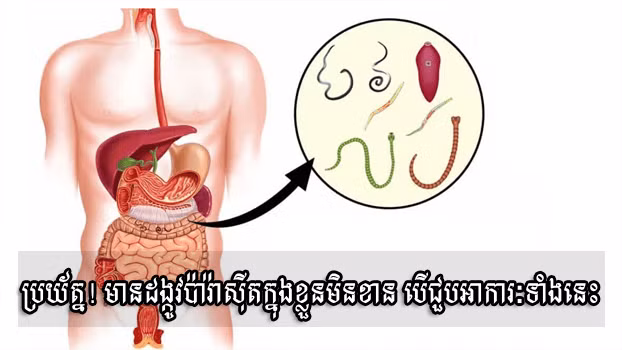 មាន​ដង្កូវ​ប៉ារ៉ាស៊ីត​ក្នុង​ខ្លួន​មិន​ខាន បើ​អាកា​រៈទាំង​នេះ​លេចឡើង​